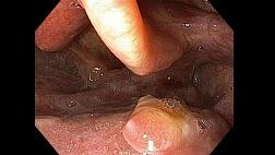 Плоскоклеточный рак ротоглотки